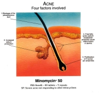 acne treatment